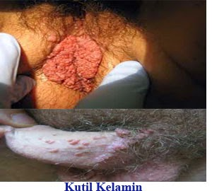 Illustration for article titled Penyebab Kutil Kelamin dan Cara Penyembuhanya